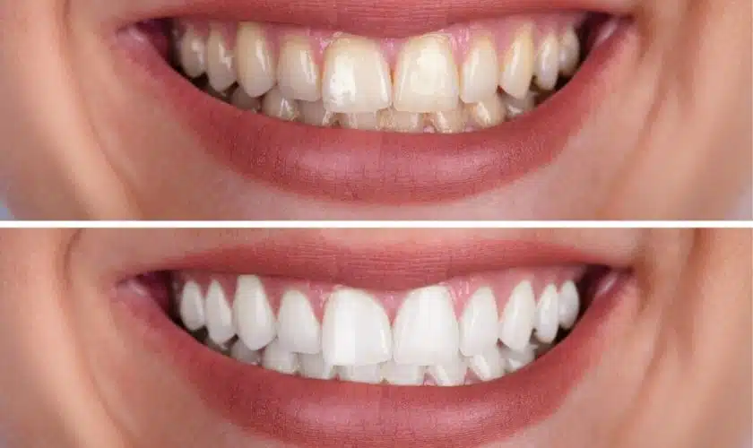 Teeth Whitening Treatment: How to Restore Your Smile’s Radiance