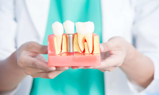 Benefits of Dental Implants Over Other Tooth Replacement Options in Dallas