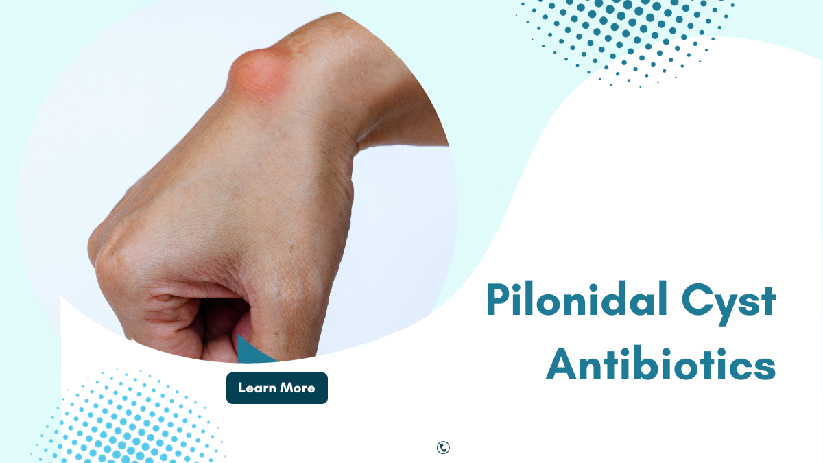 When Arе Antibiotics Prеscribеd for Pilonidal Cysts