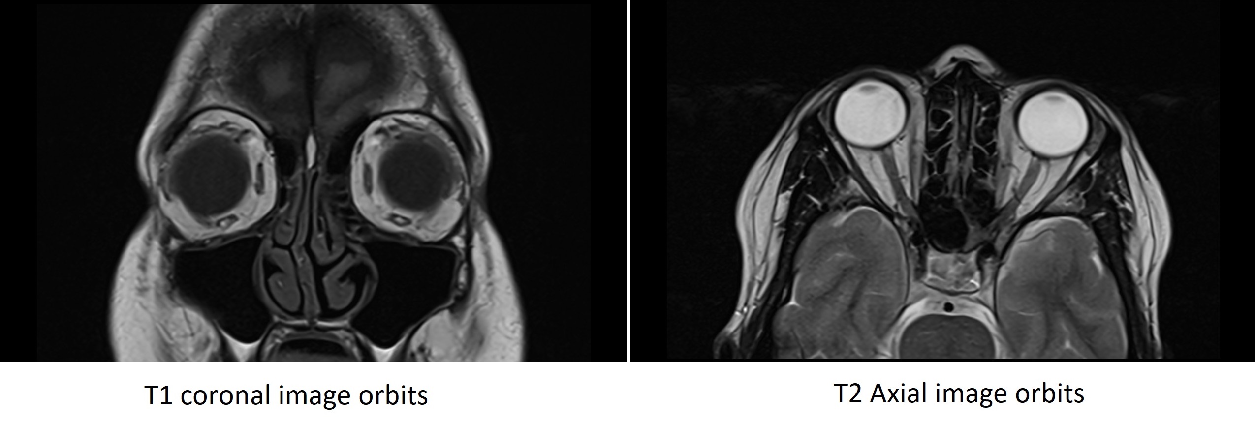 Comparative Utility of T1 vs T2 MRI in Imaging Optic Nerve Sheath Meningioma
