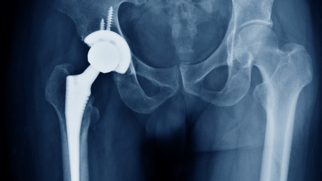 Faulty Hip Replacements Can Be Fatal: Why Exactech Lawsuits Are on the Rise?