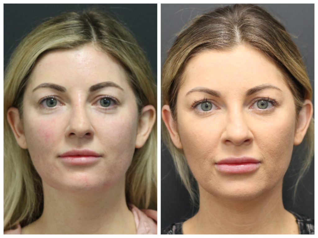 How Cosmetic Surgery Achieves Facial Balance