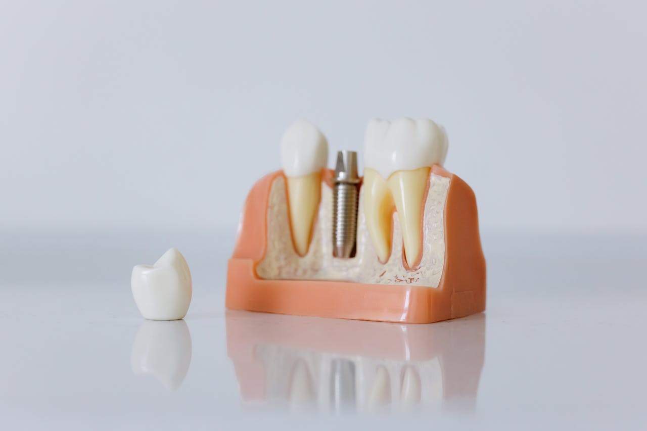 Considering Getting a Dental Implant? Keep An Eye Out for Failures