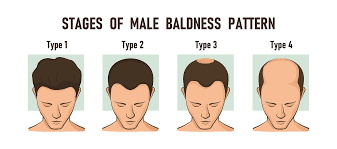 5 Types of Male Hair Loss and Potential Solutions