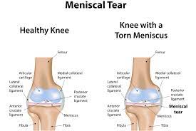 Can you tell if a meniscus is torn without an MRI?
