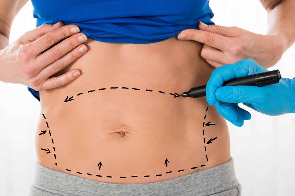 Lipo Austin Texas: A Trusted Expert in Liposuction Procedures
