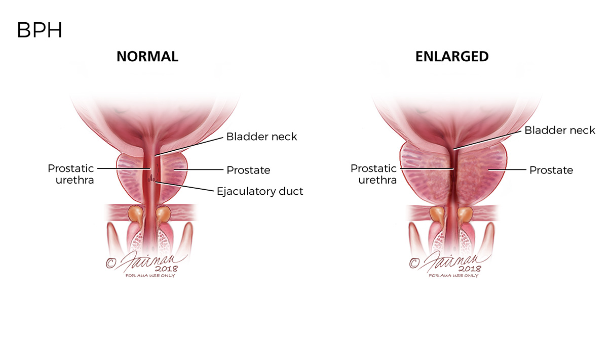 Understanding Benign Prostatic Hyperplasia: Causes, Symptoms, and Treatment