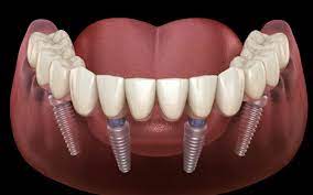 How All-On-4 Implants Can Transform Your Smile and Confidence