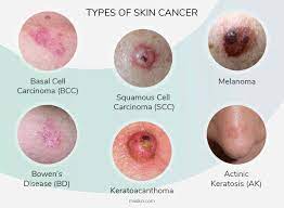 Skin Cancer Signs Diagnosis and Stages