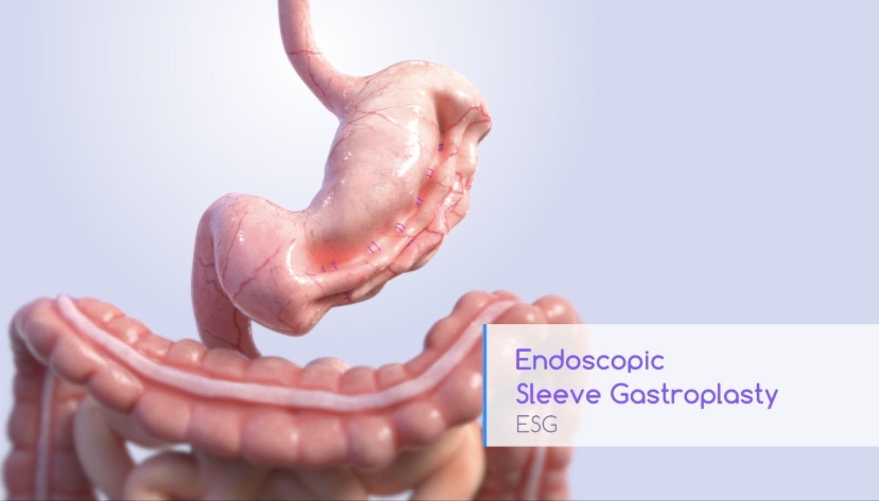 The Ultimate Guide to Endoscopic Sleeve Gastroplasty (ESG)