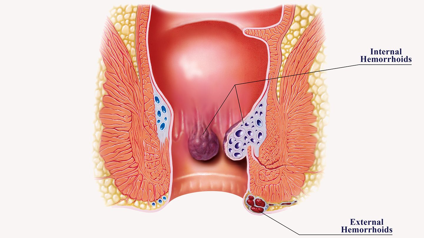 Understanding Hemorrhoids - Causes, Symptoms, and Risk Factors