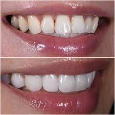 Dental Health and Aging: Preserving a Youthful Smile with Porcelain Veneers