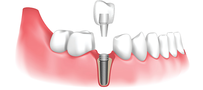 Getting the Most Out of Your Dental Implants