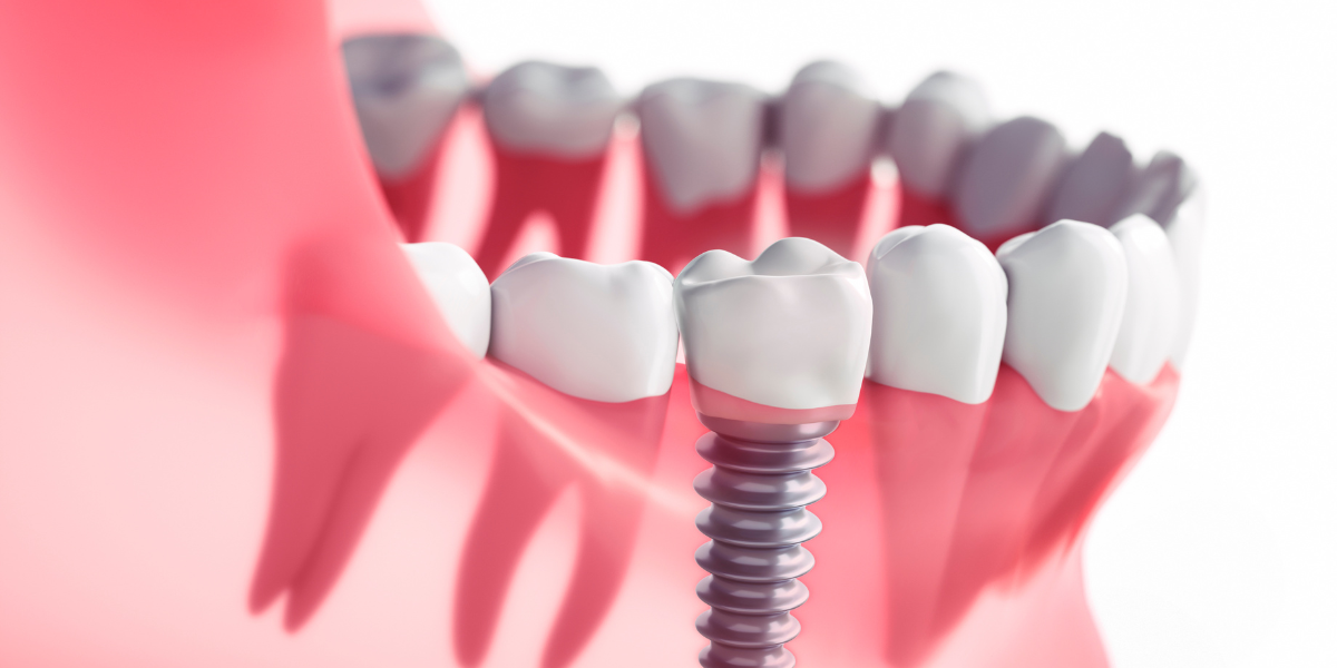 Natural Beauty, Lasting Results: with The Hesed Dental Implant