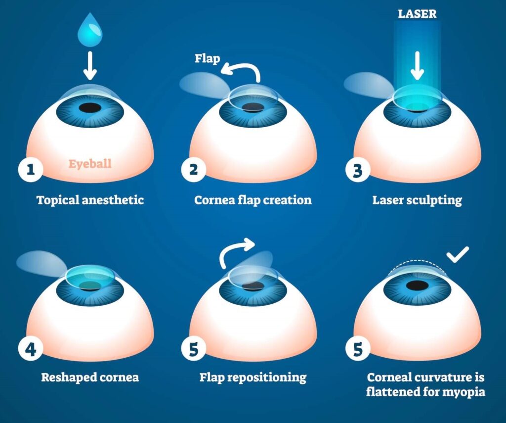 Do I Need Further Corneal Procedures After Laser Eye Surgery?