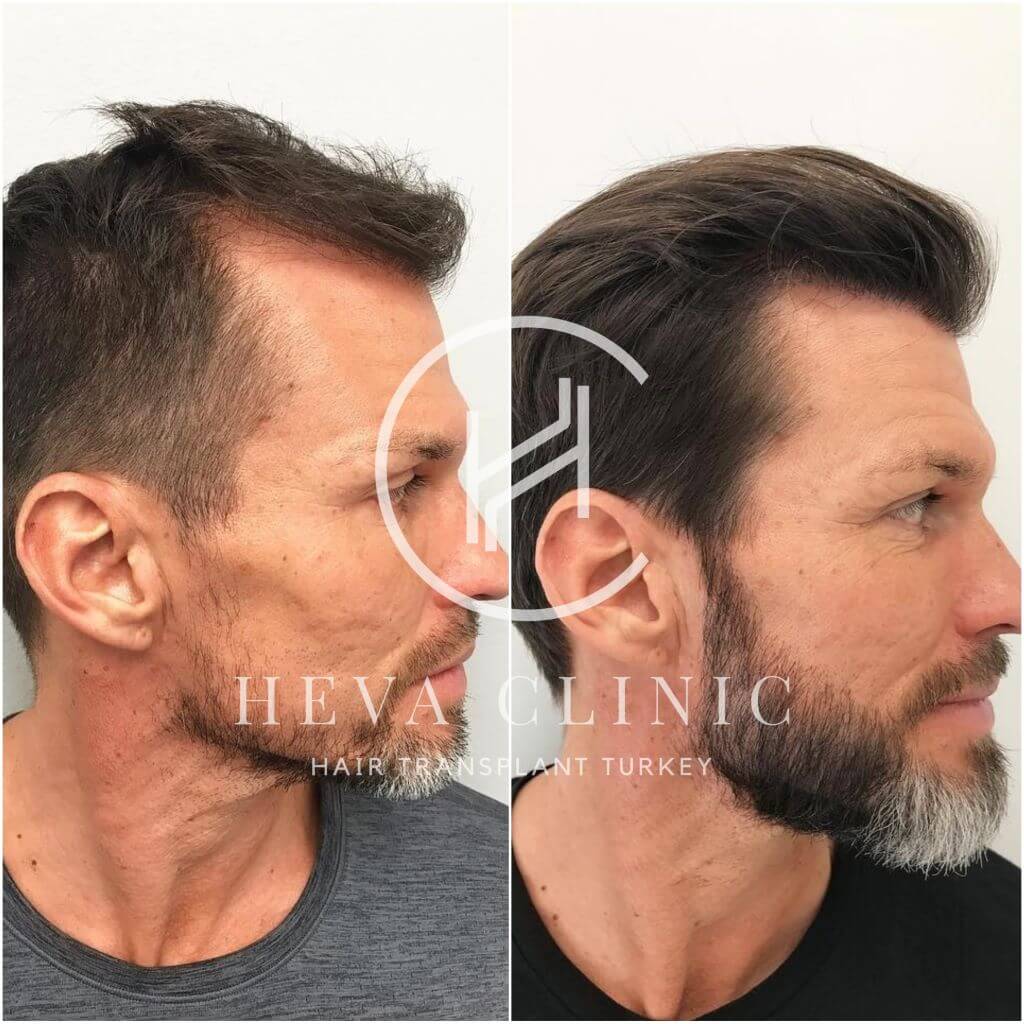 How to Prepare for a DHI Hair Transplant in Turkey