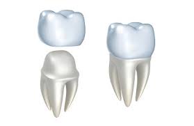 Restore Your Smile with Quality Dental Crowns in Rockville, MD