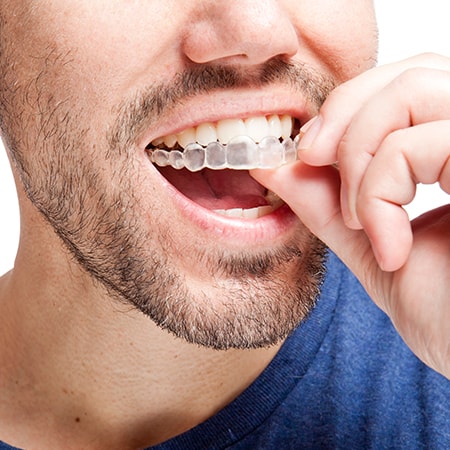 Straighten Your Teeth in Style: Invisalign Solutions in Whitby