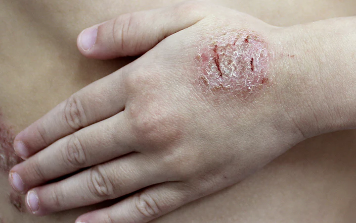 7 types of Eczema and their Ayurvedic Management