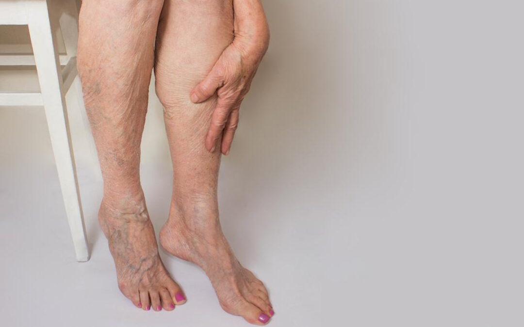 5 Most Common Risk Factors Related to the Development of Varicose Veins