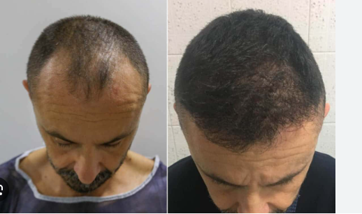 Hair Transplant: What to Expect and Is It Permanent?